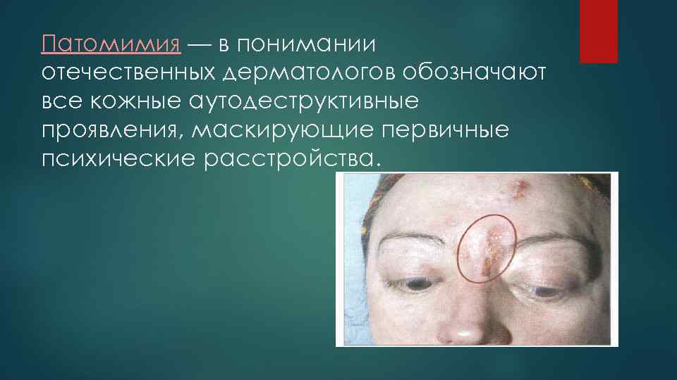 Патомимия — в понимании отечественных дерматологов обозначают все кожные аутодеструктивные проявления, маскирующие первичные психические