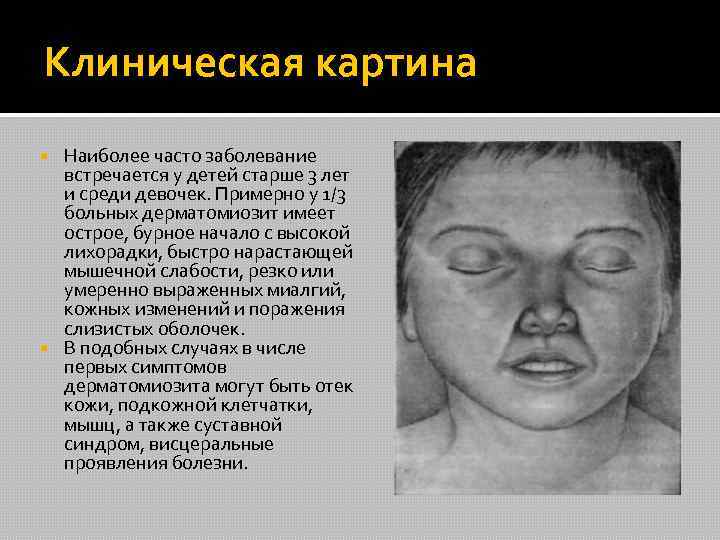 Клиническая картина Наиболее часто заболевание встречается у детей старше 3 лет и среди девочек.