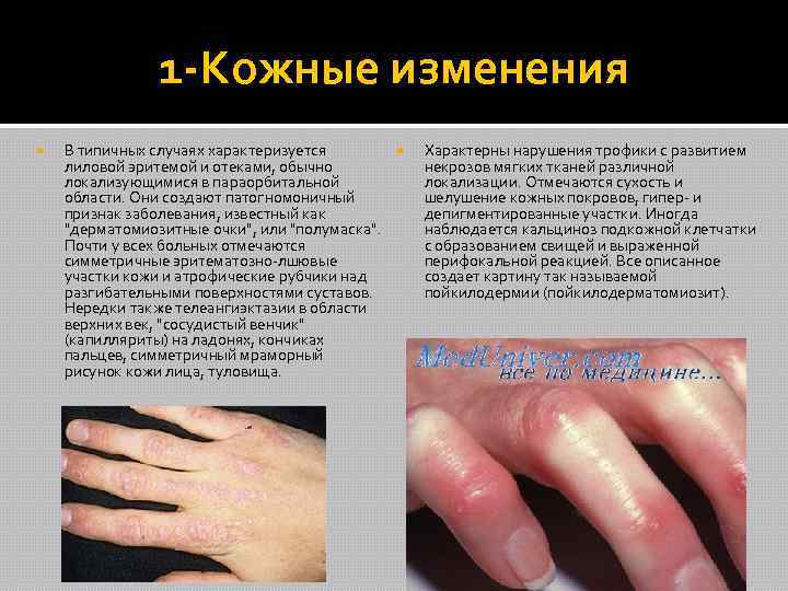  1 -Кожные изменения В типичных случаях характеризуется лиловой эритемой и отеками, обычно локализующимися