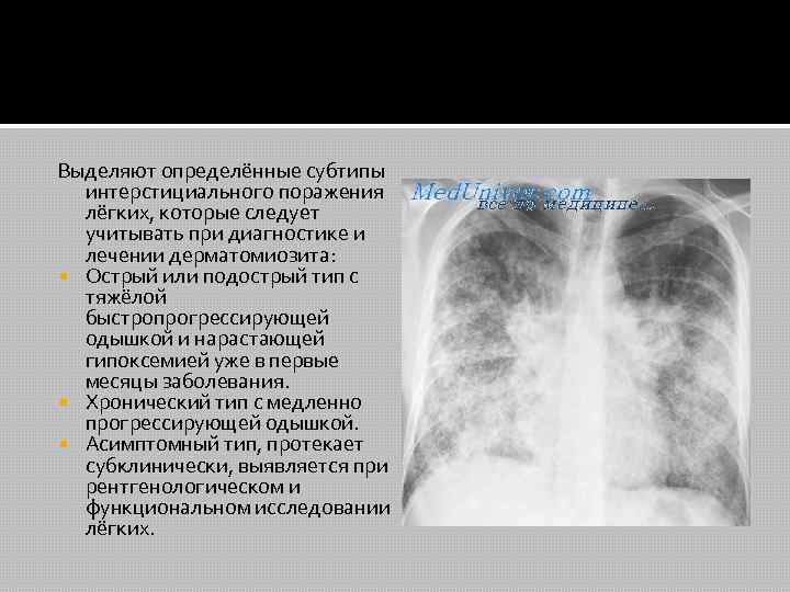Выделяют определённые субтипы интерстициального поражения лёгких, которые следует учитывать при диагностике и лечении дерматомиозита: