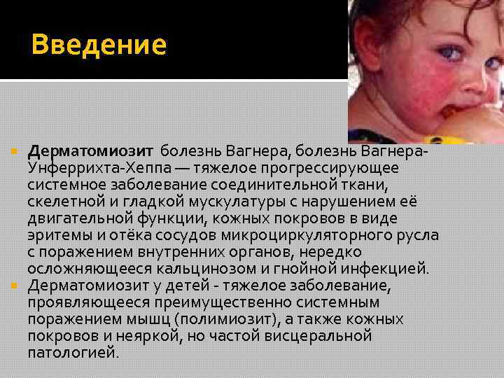 Введение Дерматомиозит болезнь Вагнера, болезнь Вагнера. Унферрихта-Хеппа — тяжелое прогрессирующее системное заболевание соединительной ткани,