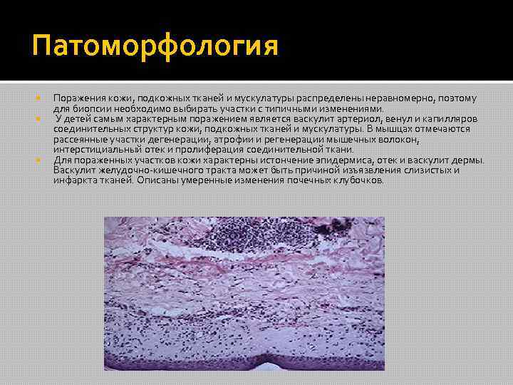 Патоморфология Поражения кожи, подкожных тканей и мускулатуры распределены неравномерно, поэтому для биопсии необходимо выбирать