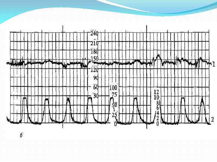 Схватки на ктг. Синусоидальный ритм КТГ. КТГ-250 конденсатор. Родовая деятельность по КТГ. Слабая родовая деятельность на КТГ.