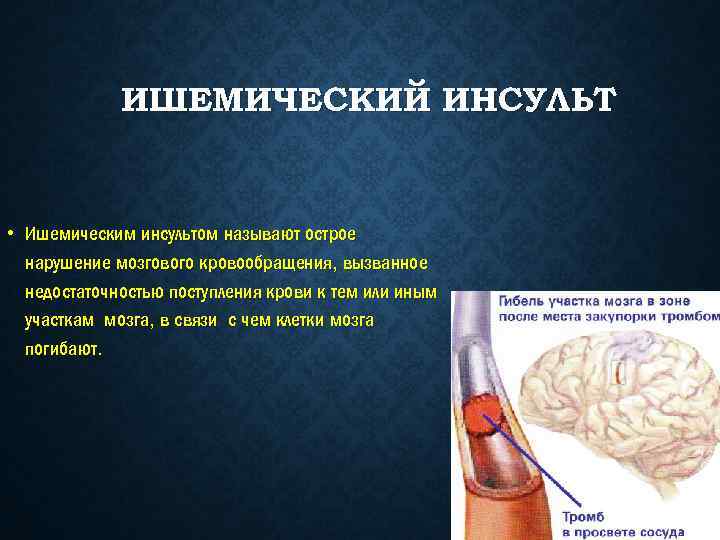 Острое нарушение мозгового кровообращения хеликс. Острый ишемический инсульт. Исходы ишемического инсульта. Ишемический инсульт при коронавирусе. Жалобы при ишемическом инсульте.