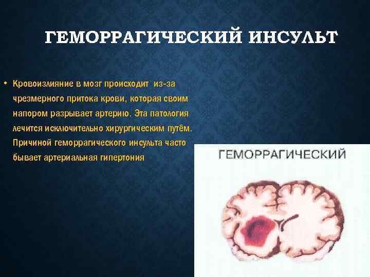 ГЕМОРРАГИЧЕСКИЙ ИНСУЛЬТ • Кровоизлияние в мозг происходит из-за чрезмерного притока крови, которая своим напором