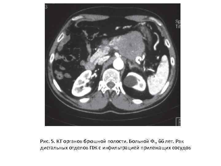 Кт органов брюшной полости. Очаговая жировая инфильтрация поджелудочной железы на кт. Карцинома в органах брюшной полости. Дистальный отдел брюшной полости. Жировая инфильтрация поджелудочной железы мкб.