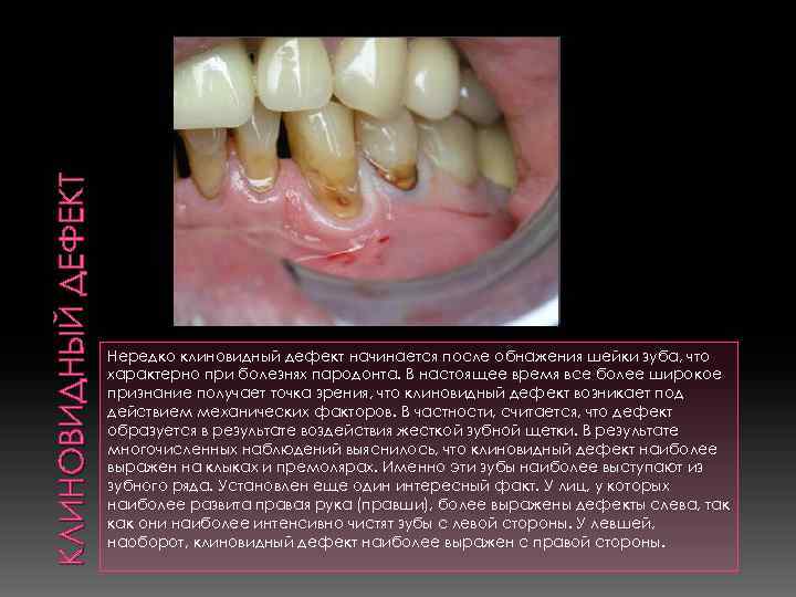 КЛИНОВИДНЫЙ ДЕФЕКТ Нередко клиновидный дефект начинается после обнажения шейки зуба, что характерно при болезнях