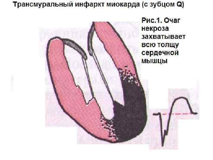 Трансмуральный инфаркт