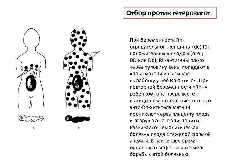 Отбор против гетерозигот. При беременности Rhотрицательной женщины (dd) Rhположительным плодом (отец DD или Dd),