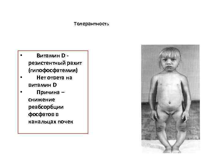 Толерантность • Витамин D резистентный рахит (гипофосфатемия) • Нет ответа на витамин D •