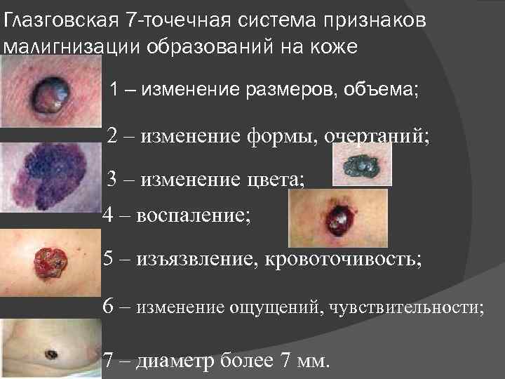 Глазговская 7 -точечная система признаков малигнизации образований на коже 1 – изменение размеров, объема;