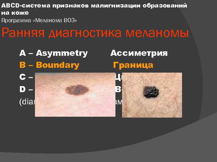 ABCD-система признаков малигнизации образований на коже Программа «Меланома ВОЗ» Ранняя диагностика меланомы A –