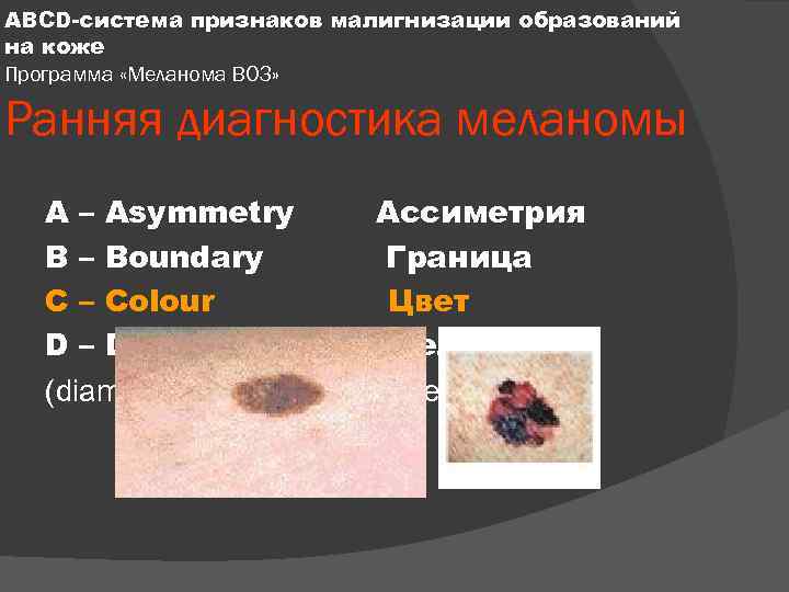 ABCD-система признаков малигнизации образований на коже Программа «Меланома ВОЗ» Ранняя диагностика меланомы A –