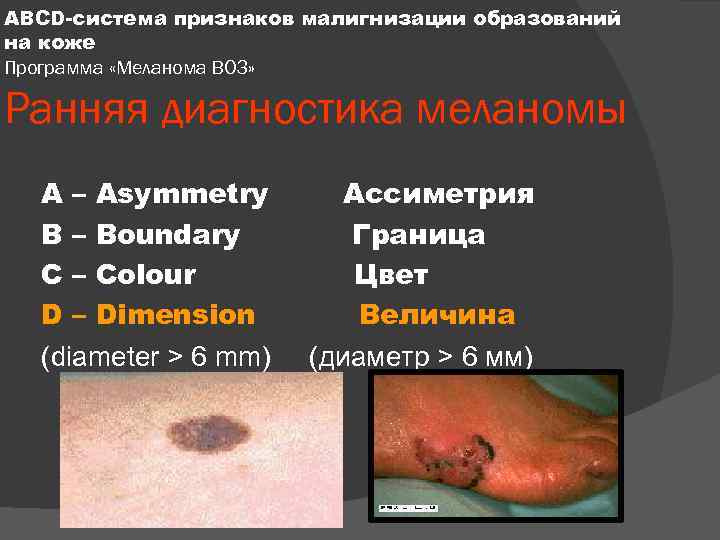 ABCD-система признаков малигнизации образований на коже Программа «Меланома ВОЗ» Ранняя диагностика меланомы A –