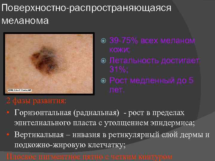 Поверхностно-распространяющаяся меланома 39 75% всех меланом кожи; Летальность достигает 31%; Рост медленный до 5