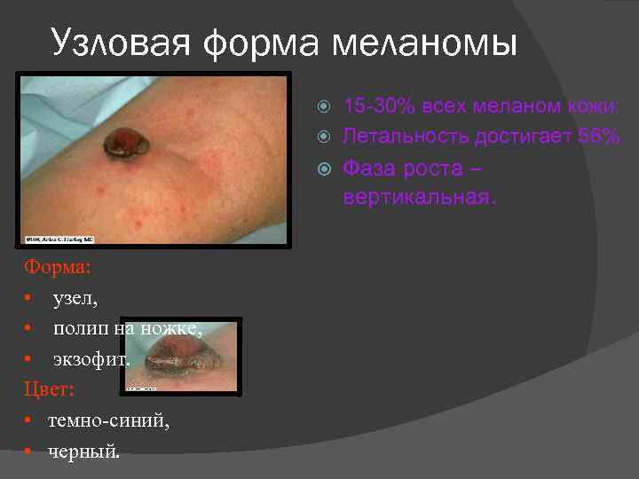 Узловая форма меланомы 15 30% всех меланом кожи; Летальность достигает 56%. Форма: • узел,