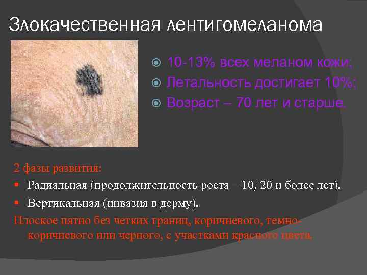 Злокачественная лентигомеланома 10 13% всех меланом кожи; Летальность достигает 10%; Возраст – 70 лет