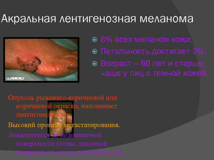 Акральная лентигенозная меланома 8% всех меланом кожи; Летальность достигает 3%; Возраст – 60 лет