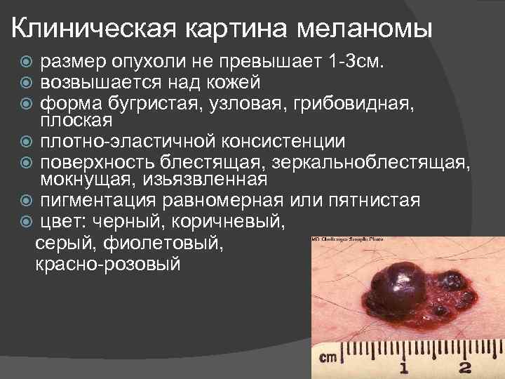 Клиническая картина меланомы размер опухоли не превышает 1 3 см. возвышается над кожей форма