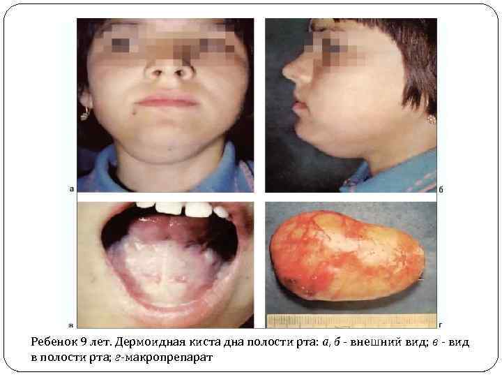 Ребенок 9 лет. Дермоидная киста дна полости рта: а, б - внешний вид; в