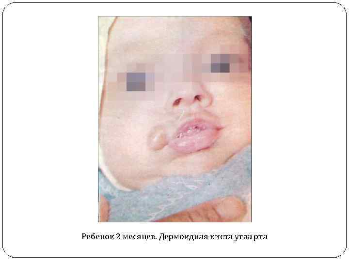 Ребенок 2 месяцев. Дермоидная киста угла рта 