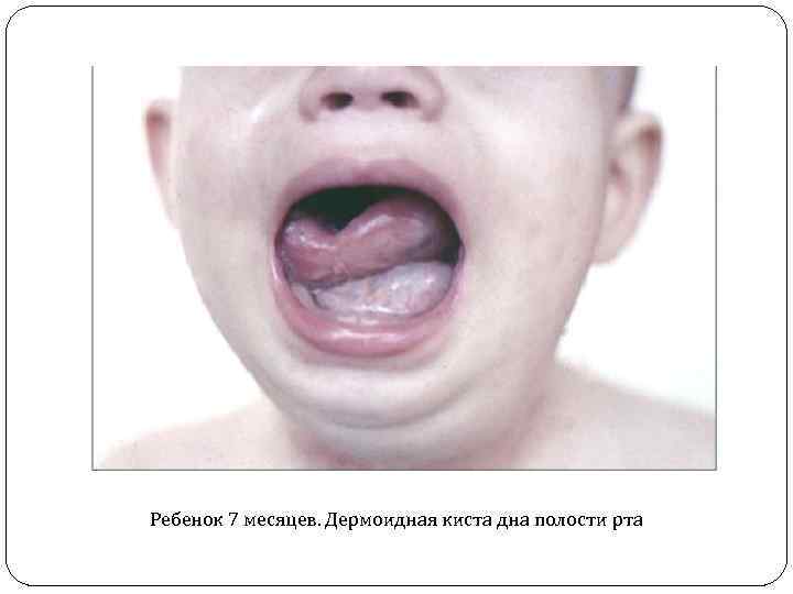 Ребенок 7 месяцев. Дермоидная киста дна полости рта 