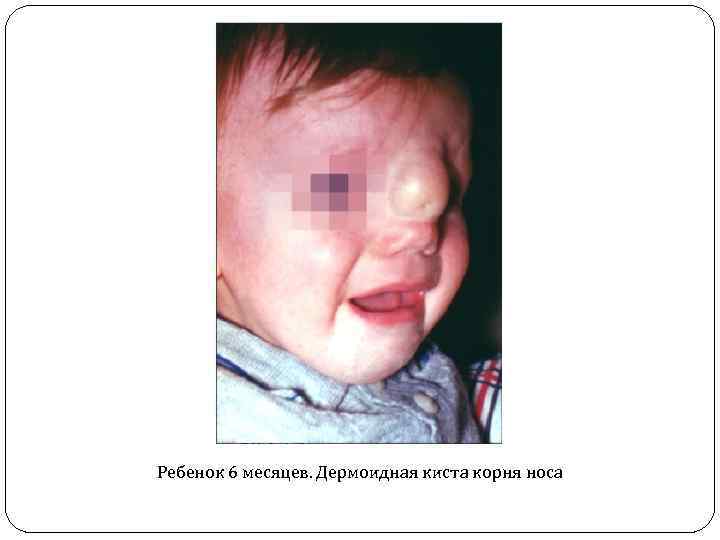 Ребенок 6 месяцев. Дермоидная киста корня носа 