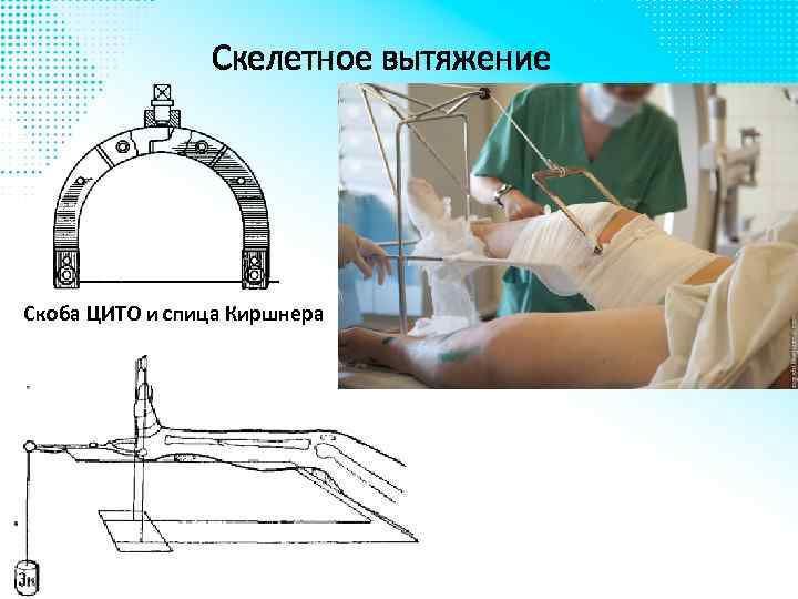 Скелетное вытяжение Скоба ЦИТО и спица Киршнера 