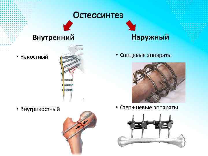 Остеосинтез Внутренний Наружный • Накостный • Спицевые аппараты • Внутрикостный • Стержневые аппараты 