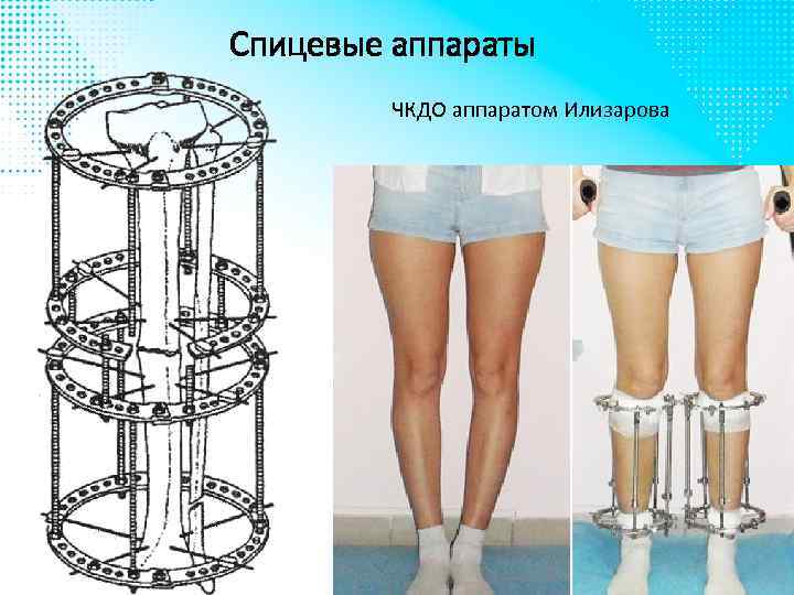 Спицевые аппараты ЧКДО аппаратом Илизарова 