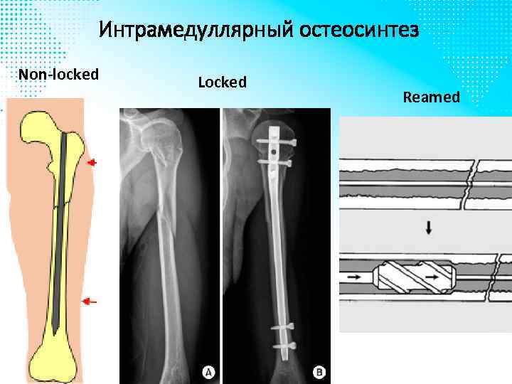 Интрамедуллярный остеосинтез Non-locked Locked Reamed 