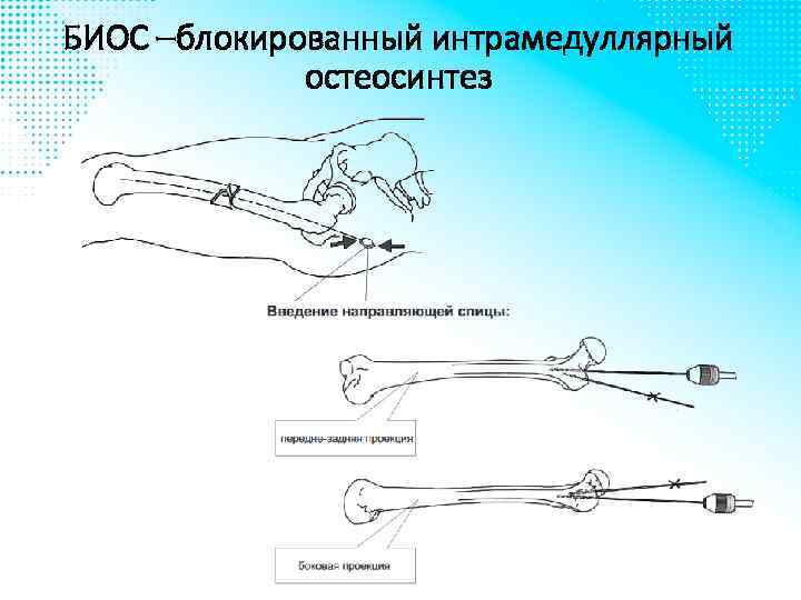 БИОС –блокированный интрамедуллярный остеосинтез 