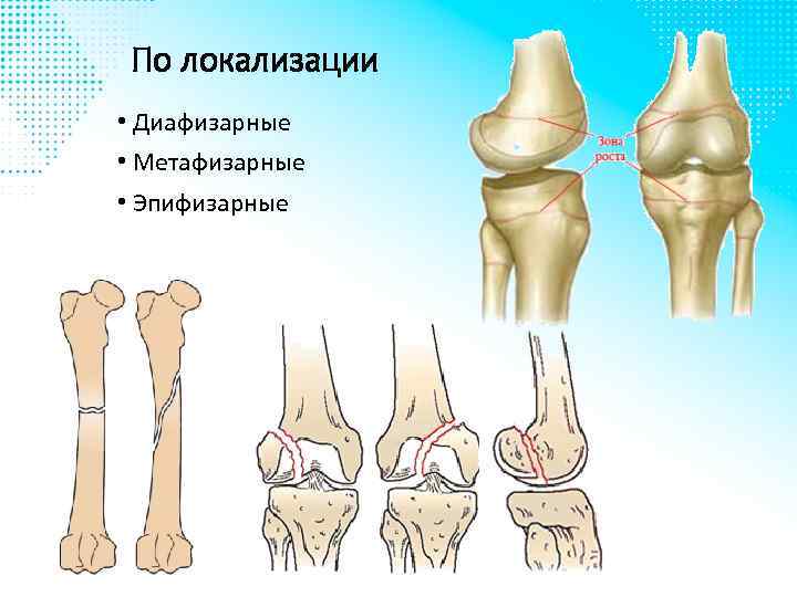 По локализации • Диафизарные • Метафизарные • Эпифизарные 