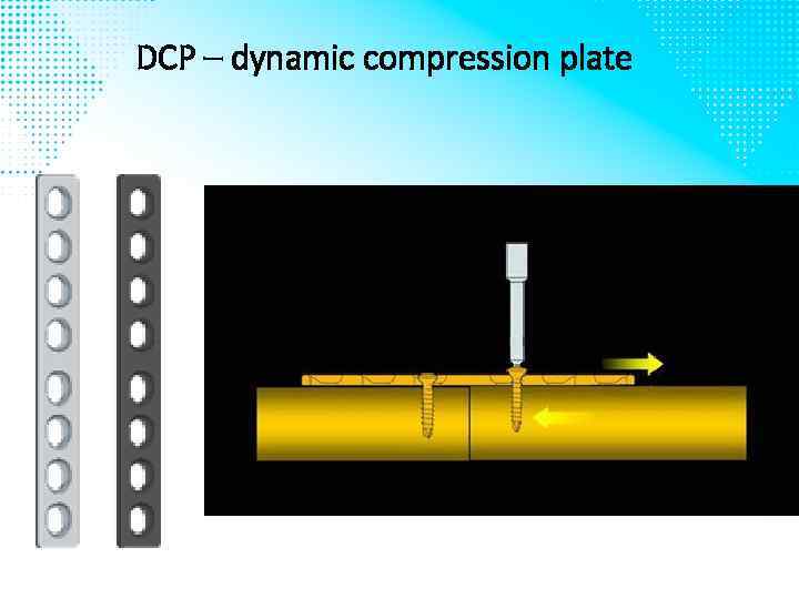 DCP – dynamic compression plate 