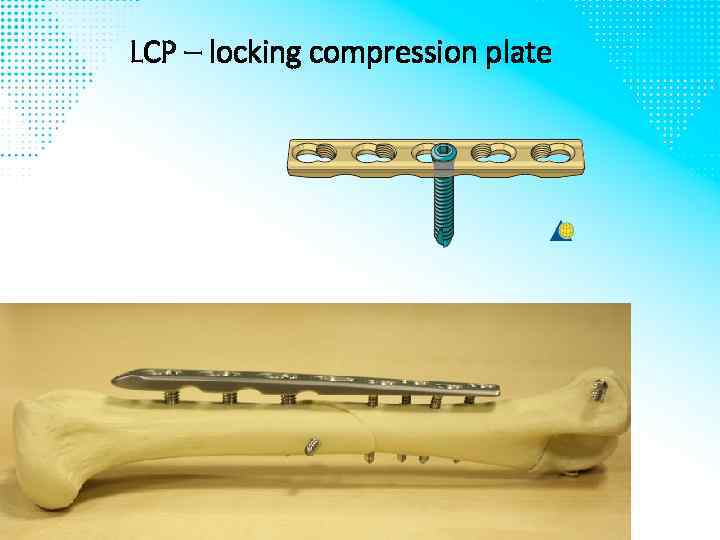 LCP – locking compression plate 