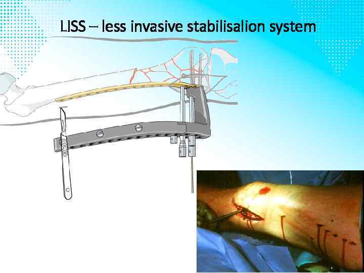 LISS – less invasive stabilisalion system 