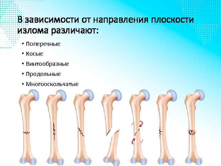 В зависимости от направления плоскости излома различают: • Поперечные • Косые • Винтообразные •