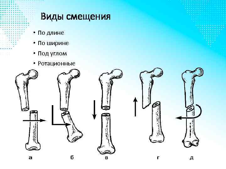 Виды смещения • По длине • По ширине • Под углом • Ротационные 