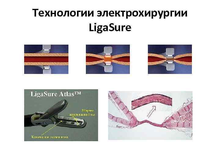 Технологии электрохирургии Liga. Sure 