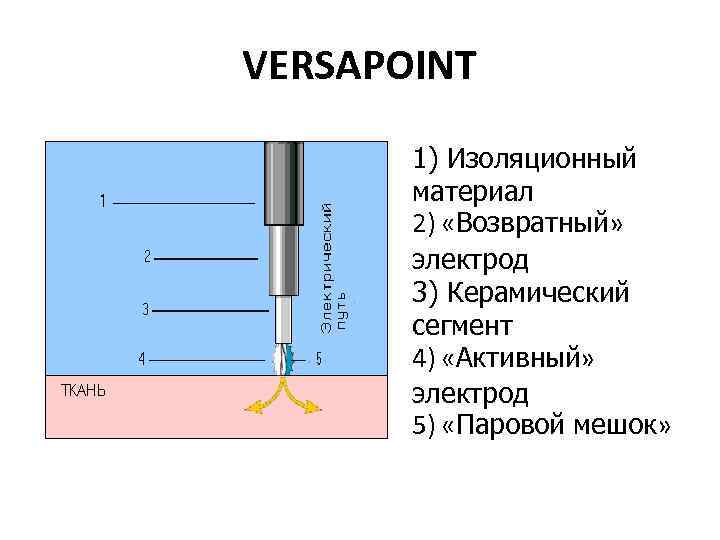 VERSAPOINT 1) Изоляционный материал 2) «Возвратный» электрод 3) Керамический сегмент 4) «Активный» электрод 5)