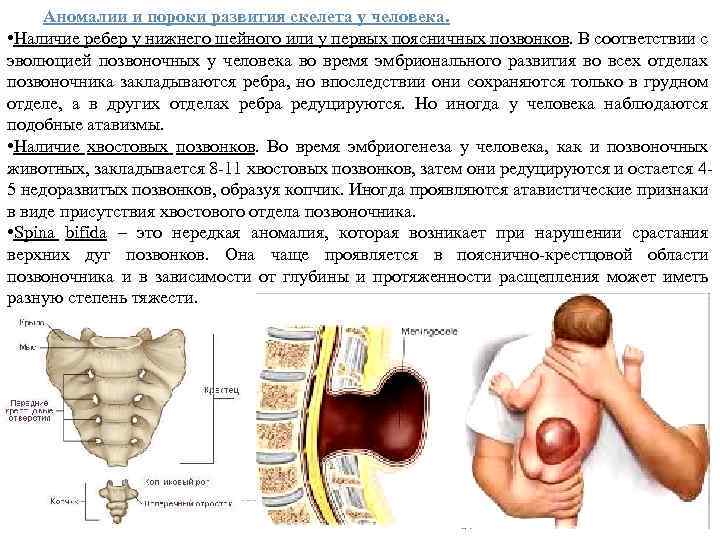 Аномалии и пороки развития скелета у человека. • Наличие ребер у нижнего шейного или