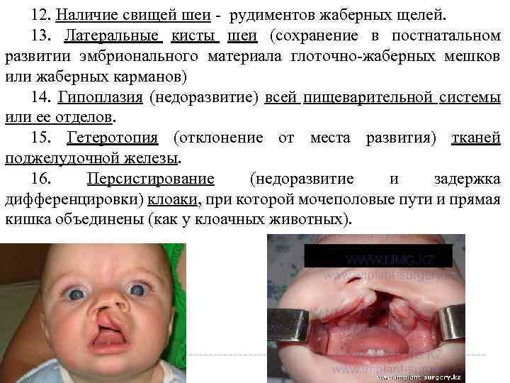 12. Наличие свищей шеи рудиментов жаберных щелей. 13. Латеральные кисты шеи (сохранение в постнатальном