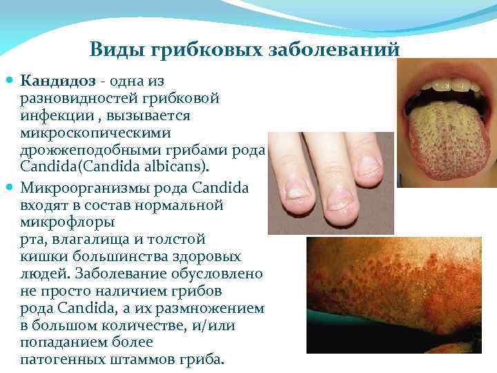 Виды грибковых заболеваний Кандидоз - одна из разновидностей грибковой инфекции , вызывается микроскопическими дрожжеподобными