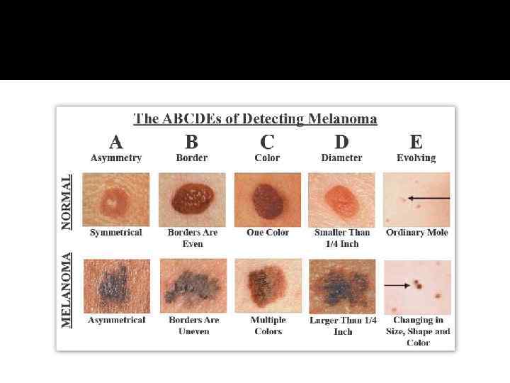 Злокачественная меланома кожи с43 7