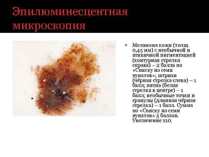 Эпилюминесцентная микроскопия Меланома кожи (толщ. 0, 45 мм) с необычной и атипичной пигментацией (контурная