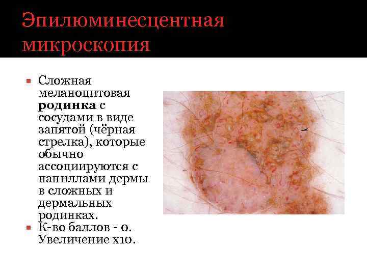 Эпилюминесцентная микроскопия Сложная меланоцитовая родинка с сосудами в виде запятой (чёрная стрелка), которые обычно