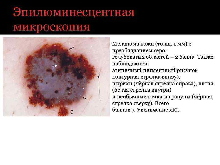 Эпилюминесцентная микроскопия Меланома кожи (толщ. 1 мм) с преобладанием сероголубоватых областей – 2 балла.
