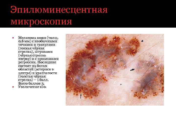 Эпилюминесцентная микроскопия Меланома кожи (толщ. 0, 6 мм) с необычными точками и гранулами (тонкая