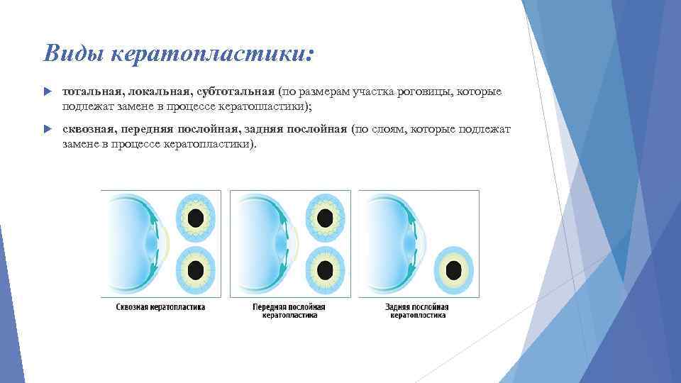 Виды кератопластики: тотальная, локальная, субтотальная (по размерам участка роговицы, которые подлежат замене в процессе