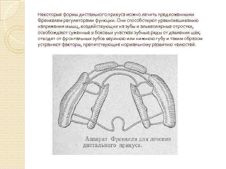 Некоторые формы дистального прикуса можно лечить предложенными Френкелем регуляторами функции. Они способствуют уравновешиванию напряжения